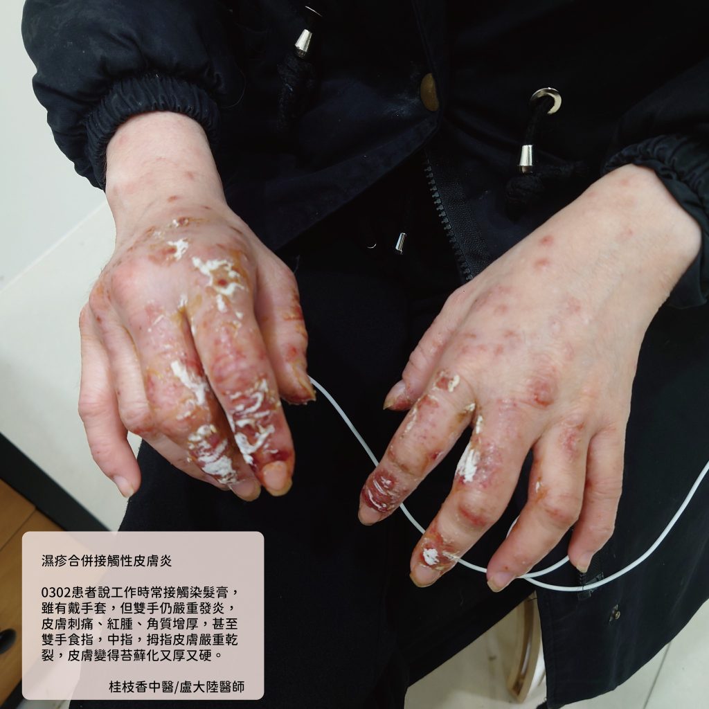 中醫使用青黛膏治療濕疹與乾癬|盧大陸中醫師案例