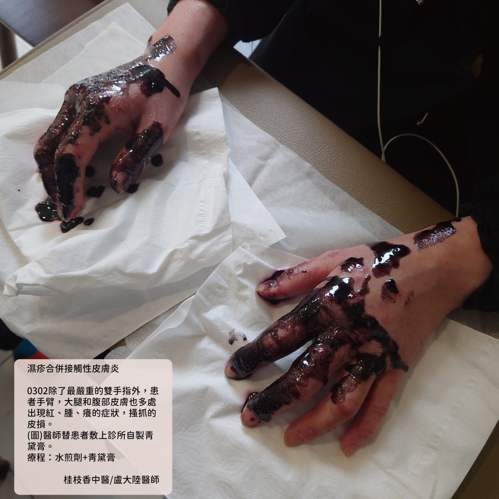 中醫使用青黛膏治療濕疹與乾癬|盧大陸中醫師案例