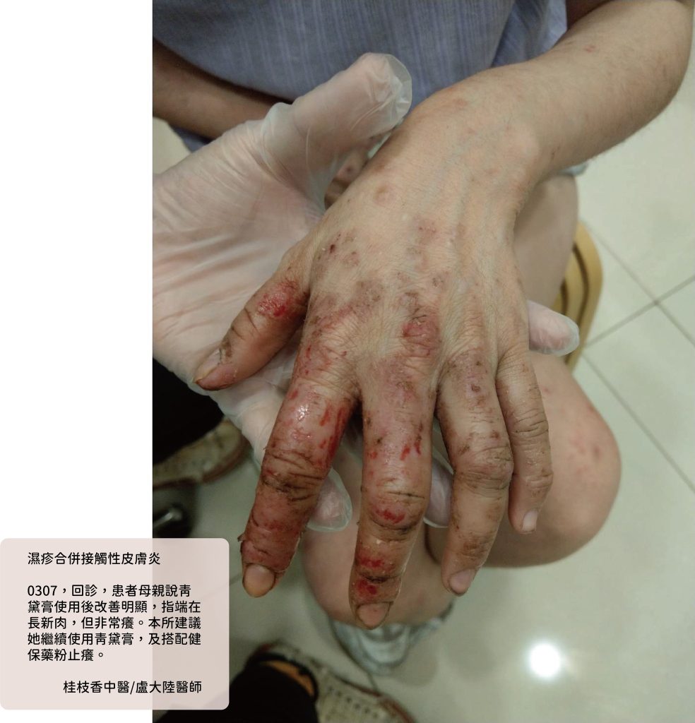 中醫使用青黛膏治療濕疹與乾癬|盧大陸中醫師案例