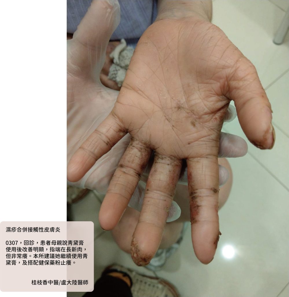 中醫使用青黛膏治療濕疹與乾癬|盧大陸中醫師案例