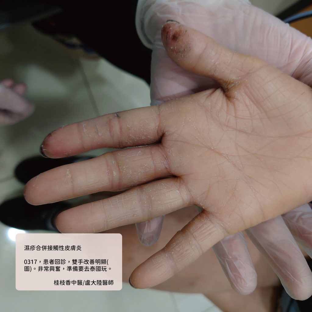 中醫使用青黛膏治療濕疹與乾癬|盧大陸中醫師案例