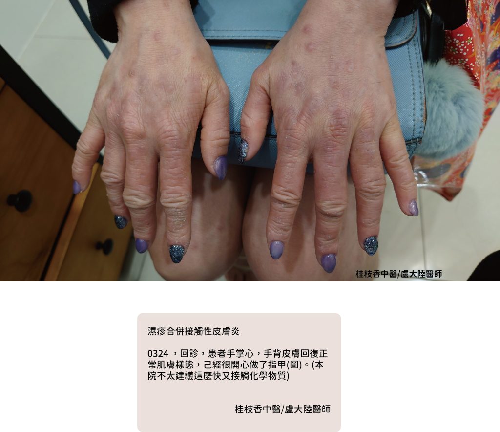 中醫使用青黛膏治療濕疹與乾癬|盧大陸中醫師案例
