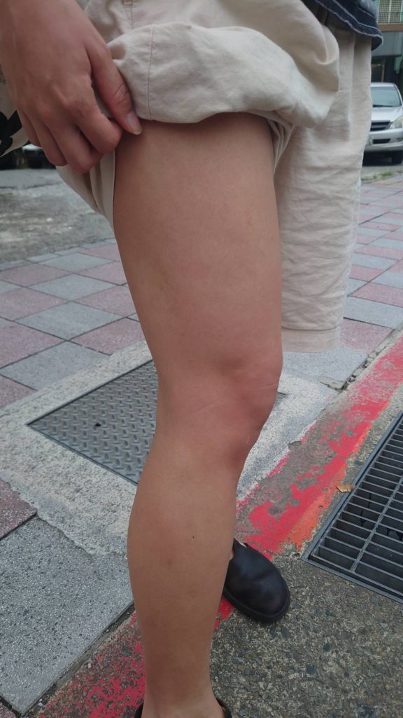 中醫治療蕁麻疹